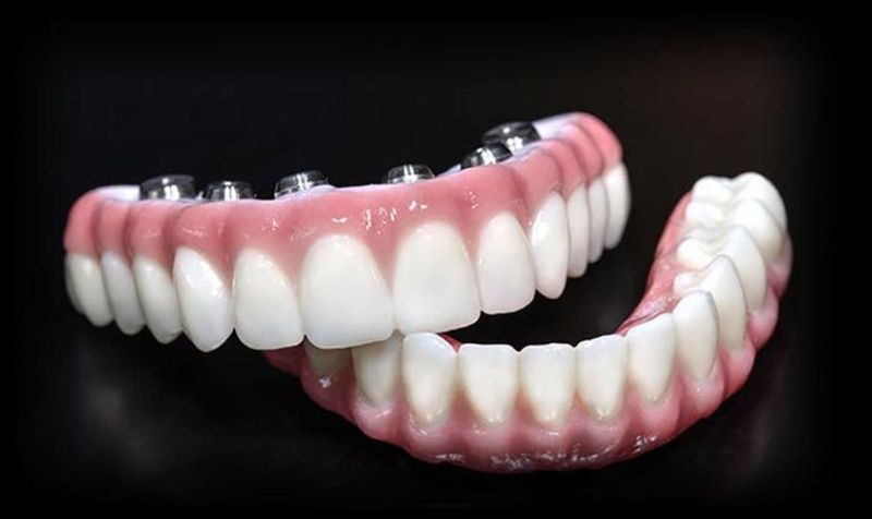 Full Arch Implants