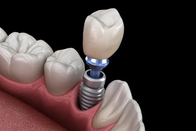 Single Tooth Implants