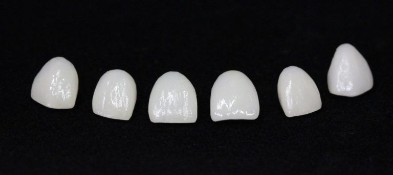 Veneers