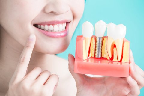 Dental Implants Ocoee